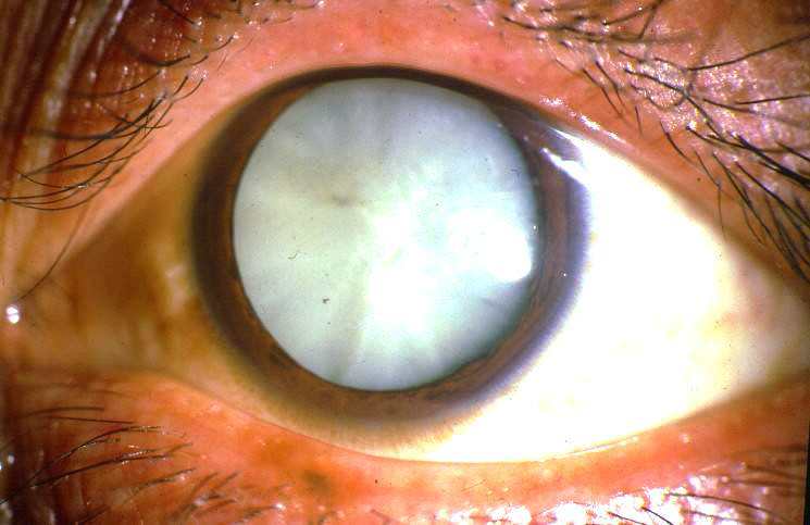 白内障医治.jpg 白内障医治.jpg