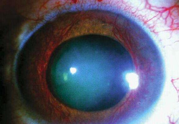 青光眼医治.jpg 青光眼医治.jpg