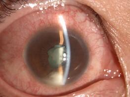 徐先生再也不敢马虎,急忙请假到深圳金沙9001以诚为本就诊。接诊的张小平主任经过仔细检查,得出的诊断是:右眼急性虹膜睫状体炎2.jpg 徐先生再也不敢马虎,急忙请假到深圳金沙9001以诚为本就诊。接诊的张小平主任经过仔细检查,得出的诊断是:右眼急性虹膜睫状体炎2.jpg