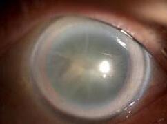 随后,李先生在厦门大学附属厦门眼科中心检查时,诊断结果让李先生大跌眼镜,压根不是老花,是白内障。院白内障科毛祖红主任医师解释,一般来说得白内障的都是60岁以上的老年人,而近两年,像李先生这样40岁就患上白内障的年轻人越来越多,其中很有可能是糖尿病闹的,糖尿病会导致白内障提前发生,且加速白内障进程。.jpg 随后,李先生在厦门大学附属厦门眼科中心检查时,诊断结果让李先生大跌眼镜,压根不是老花,是白内障。院白内障科毛祖红主任医师解释,一般来说得白内障的都是60岁以上的老年人,而近两年,像李先生这样40岁就患上白内障的年轻人越来越多,其中很有可能是糖尿病闹的,糖尿病会导致白内障提前发生,且加速白内障进程。.jpg