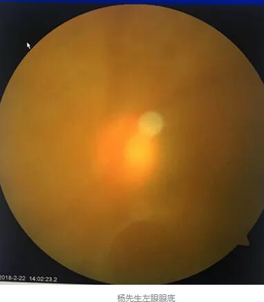 白内障和青光眼都是致盲性眼病，其中青光眼的病程不逆转。杨先生拖延伤情导致同时并发白内障、青光眼的情况，十分令人惋惜。”出名眼科专家、成都金沙9001以诚为本陈晓明教授表示3.jpg