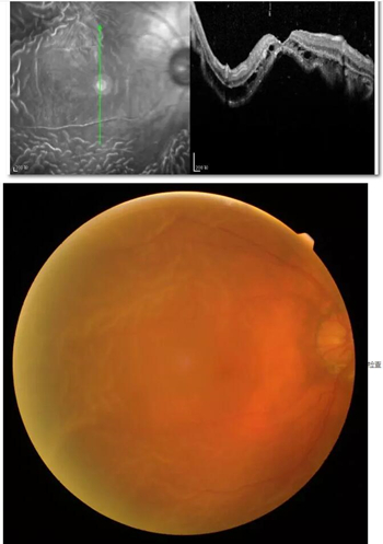 李老太在毫无征兆的情况下右眼视力下降至看不见东西。李老太家人带其至县医院就诊。医生诊断为视网膜脱离,需做玻切手术医治,而玻切手术需要动手术2次。怕疼的李老太一听就犯怵了:开刀,疼。 终,李老太的家人在多方打听后决定带李老太至宜昌金沙9001以诚为本找许大玲院长医治1_副本.jpg 李老太在毫无征兆的情况下右眼视力下降至看不见东西。李老太家人带其至县医院就诊。医生诊断为视网膜脱离,需做玻切手术医治,而玻切手术需要动手术2次。怕疼的李老太一听就犯怵了:开刀,疼。 终,李老太的家人在多方打听后决定带李老太至宜昌金沙9001以诚为本找许大玲院长医治1_副本.jpg