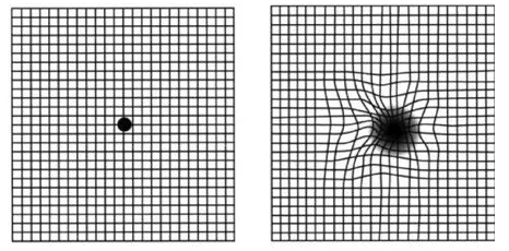 老年黄斑变性其实是眼部黄斑区结构的衰老性改变引起的眼病。“黄斑”是位于视网膜核心区的一个生理结构,一旦黄斑区的视神经细胞被破坏,就会引起患者中心视力下降、视物变形、色暗等3.png 老年黄斑变性其实是眼部黄斑区结构的衰老性改变引起的眼病。“黄斑”是位于视网膜核心区的一个生理结构,一旦黄斑区的视神经细胞被破坏,就会引起患者中心视力下降、视物变形、色暗等3.png