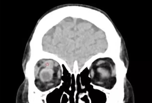 甲状腺相关眼病2.png 甲状腺相关眼病2.png