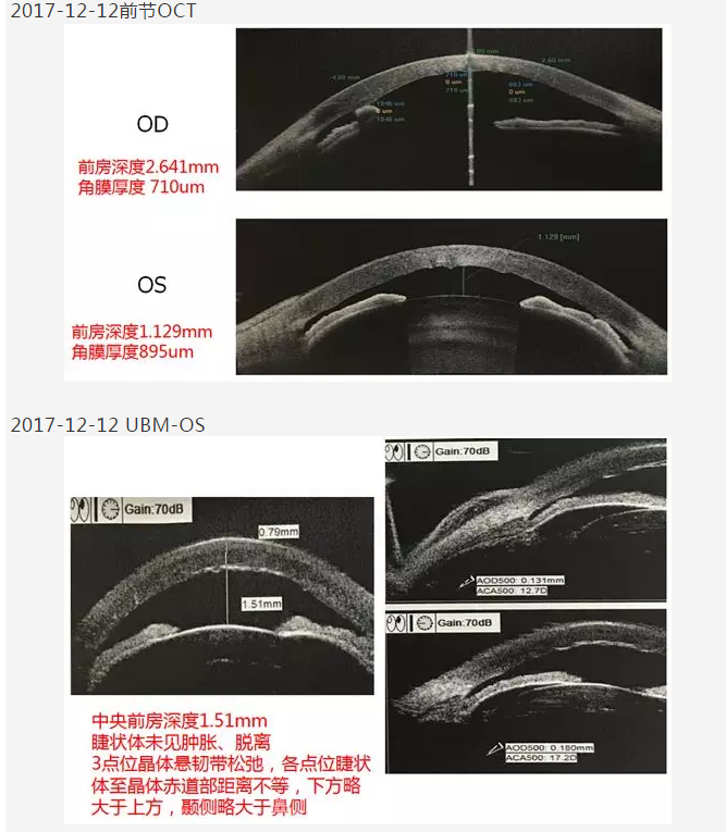 厦门眼科中心复杂性白内障手术案 研讨会持续进行9.png