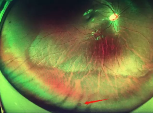 想要摘镜参军在深圳金沙9001以诚为本查出视网膜裂孔 细心妈妈挽救孩子视网膜1.png 想要摘镜参军在深圳金沙9001以诚为本查出视网膜裂孔 细心妈妈挽救孩子视网膜1.png