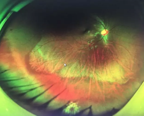 想要摘镜参军在深圳金沙9001以诚为本查出视网膜裂孔 细心妈妈挽救孩子视网膜2.png 想要摘镜参军在深圳金沙9001以诚为本查出视网膜裂孔 细心妈妈挽救孩子视网膜2.png