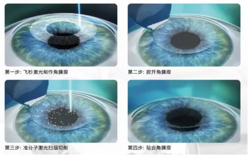 飞秒全激光手术.png