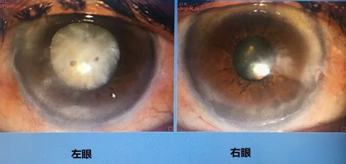 同时患 青光眼、白内障老婆婆辗转几家医院之后终于在成都金沙9001以诚为本顺利手术2.png 同时患 青光眼、白内障老婆婆辗转几家医院之后终于在成都金沙9001以诚为本顺利手术2.png