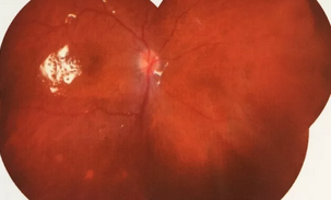 葡萄膜炎等多种眼底病患者跪地感谢深圳金沙9001以诚为本院长赵铁英教授1.png 葡萄膜炎等多种眼底病患者跪地感谢深圳金沙9001以诚为本院长赵铁英教授1.png