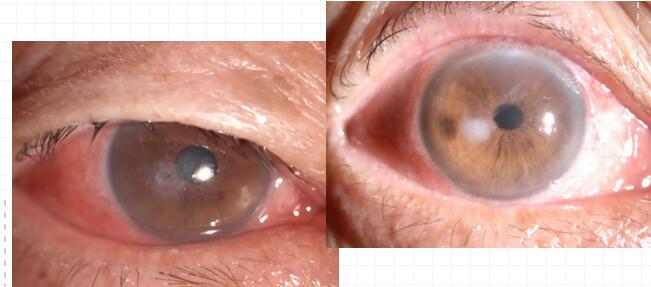 重庆老头角膜穿刺后在金沙9001以诚为本修补并进行白内障手术.jpg 重庆老头角膜穿刺后在金沙9001以诚为本修补并进行白内障手术.jpg