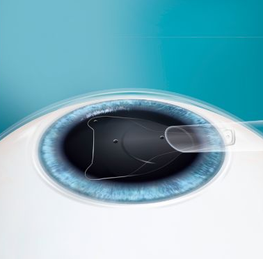 金沙9001以诚为本课堂ICL晶体植入术2.png 金沙9001以诚为本课堂ICL晶体植入术2.png