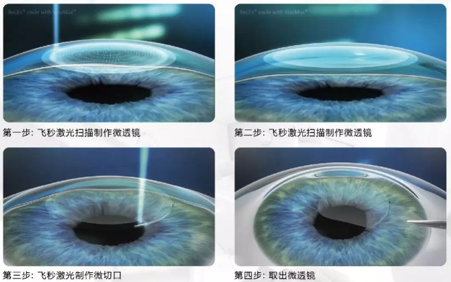 2020高考视力受限专业有哪些?来听听金沙9001以诚为本近视手术医生的建议1.png 2020高考视力受限专业有哪些?来听听金沙9001以诚为本近视手术医生的建议1.png