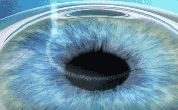 7月26日来深圳金沙9001以诚为本参与暑期摘镜季活动就可以有机会参与抽奖免单手术!1.gif 7月26日来深圳金沙9001以诚为本参与暑期摘镜季活动就可以有机会参与抽奖免单手术!1.gif