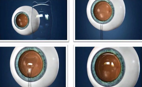 ICL晶体可以使用多久,做完手术会反*吗?金沙9001以诚为本医生这样说1.png ICL晶体可以使用多久,做完手术会反*吗?金沙9001以诚为本医生这样说1.png