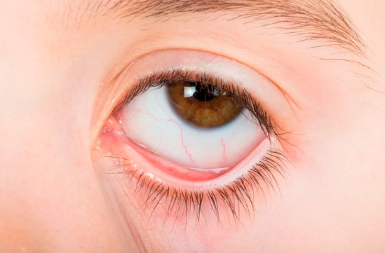 一女子右眼取出28条虫,竟然还在蠕动......厦门眼科中心接诊3.png 一女子右眼取出28条虫,竟然还在蠕动......厦门眼科中心接诊3.png